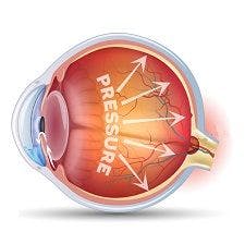 BAK-Free Latanoprost for Open-Angle Glaucoma, Ocular Hypertension