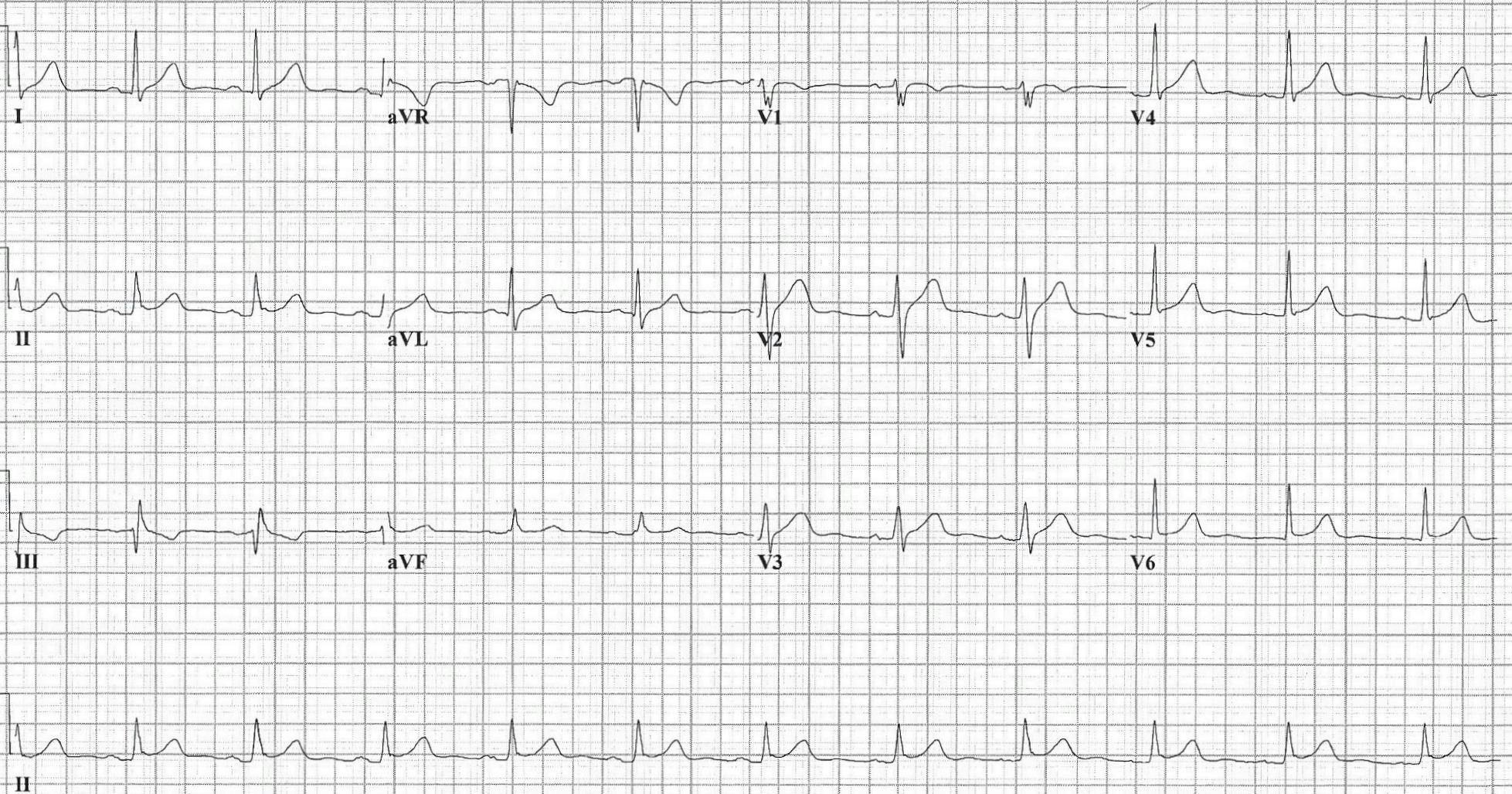 EKG of a patient with epigastric pain