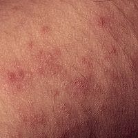 Shortage of Natural Acid Triggers Eczema