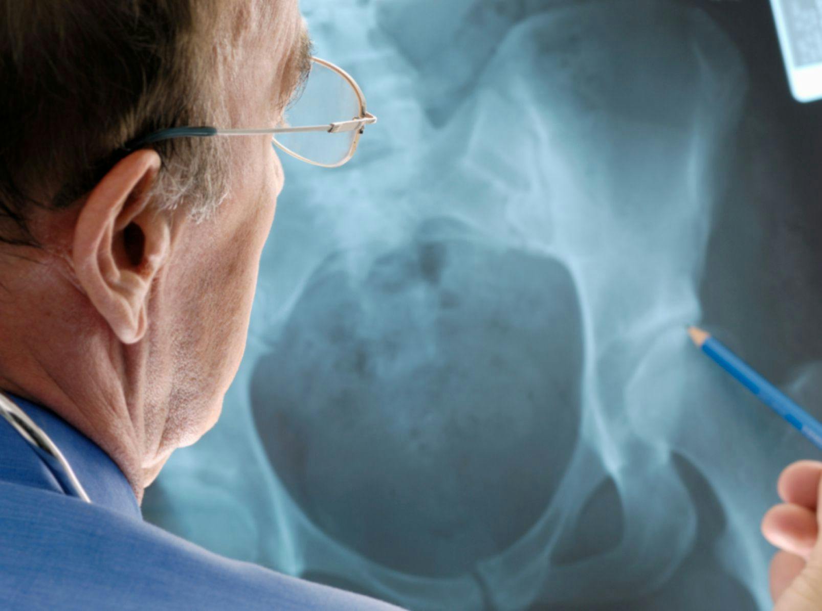 COVID-19 Pandemic Has Slowed Diagnoses, Treatment of Osteoporosis 