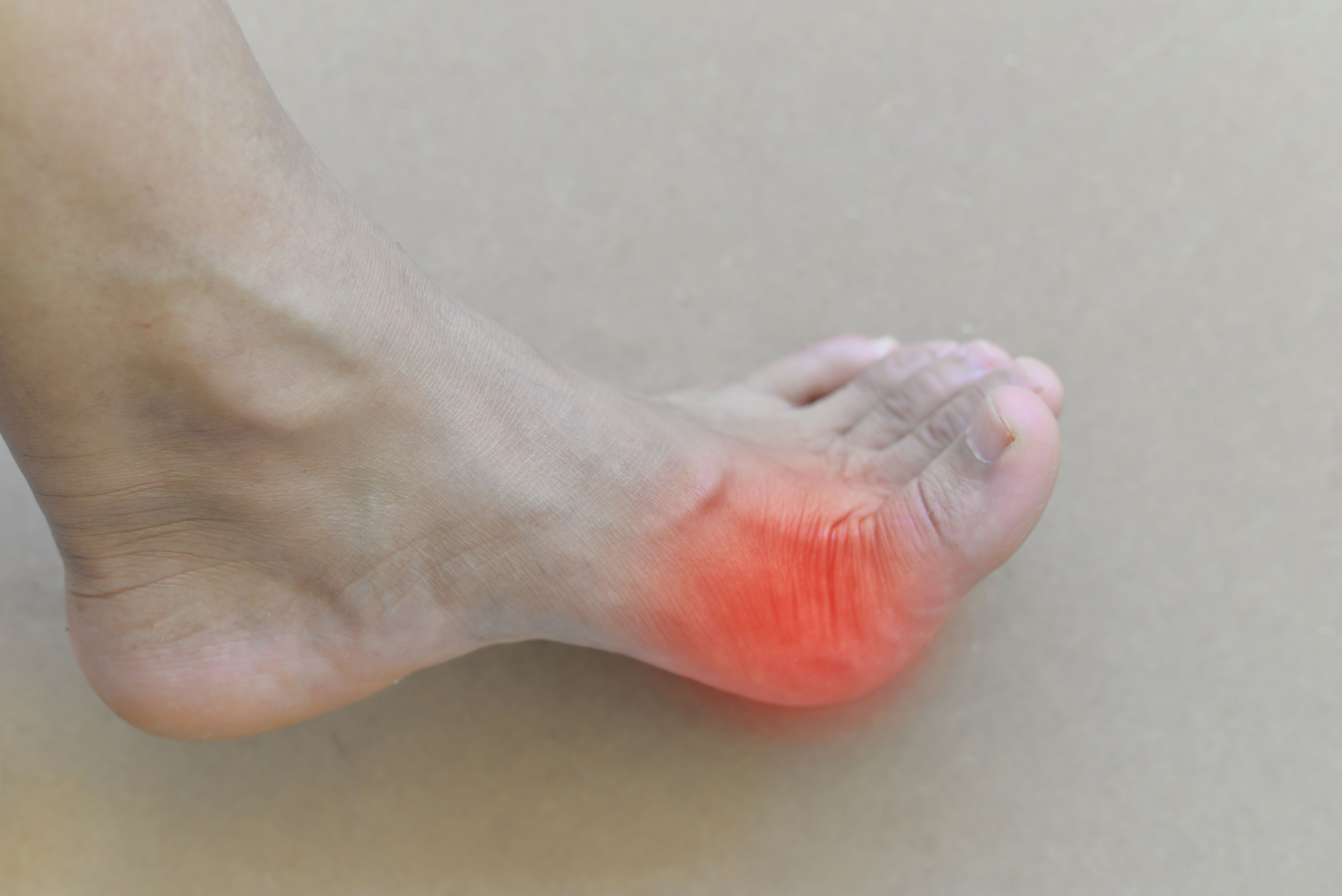 Early Gout Onset, Tophaceous Disease in Men Linked to Risk Alleles 