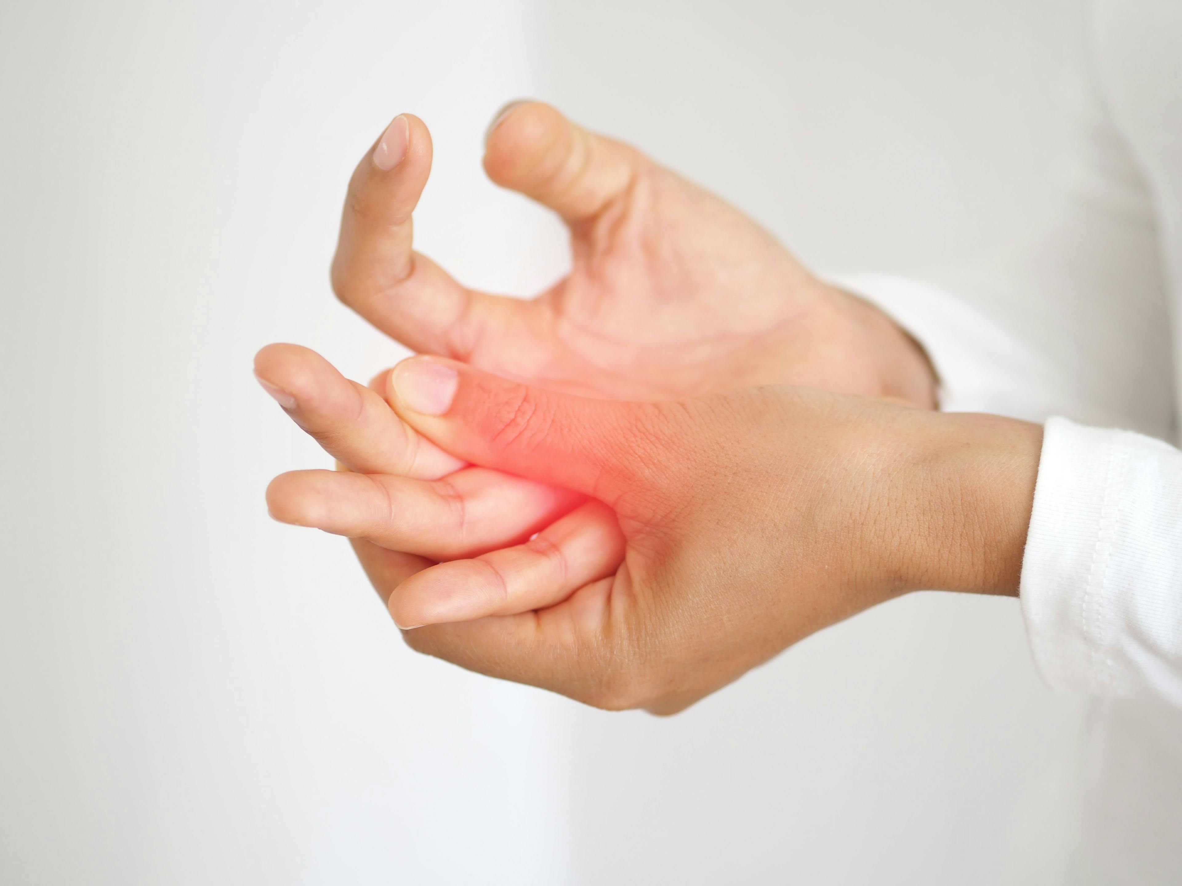 Apremilast Use May Delay Initiation of Biologics in Psoriatic Arthritis
