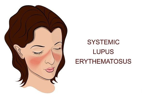 Type I Interferon Inhibition Could Benefit Systemic Lupus Erythematosus