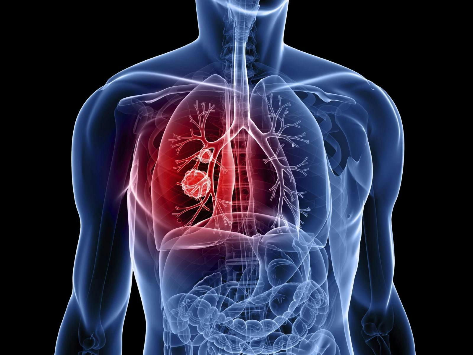 Afatinib Approval Expanded for Rare Lung Cancer Treatment