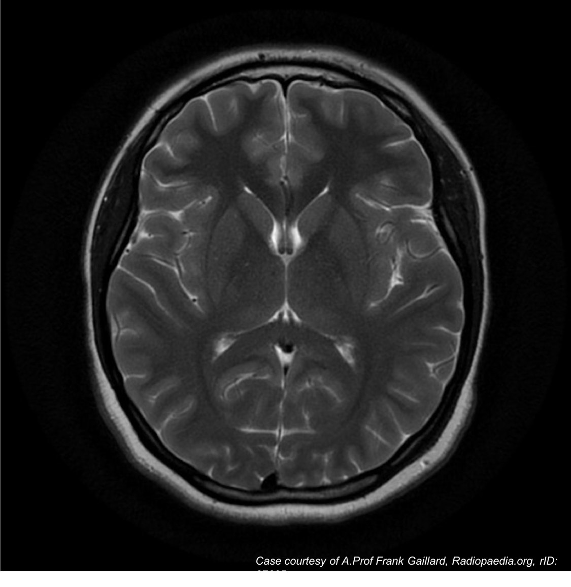 Possible Relationship between Tardive Dyskinesia and Gray Matter Volume