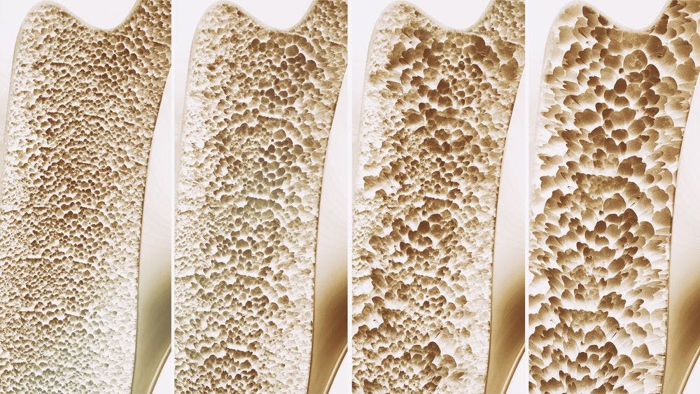 No Need to Routinely Screen Osteoporosis Patients for Coeliac Disease, celiac