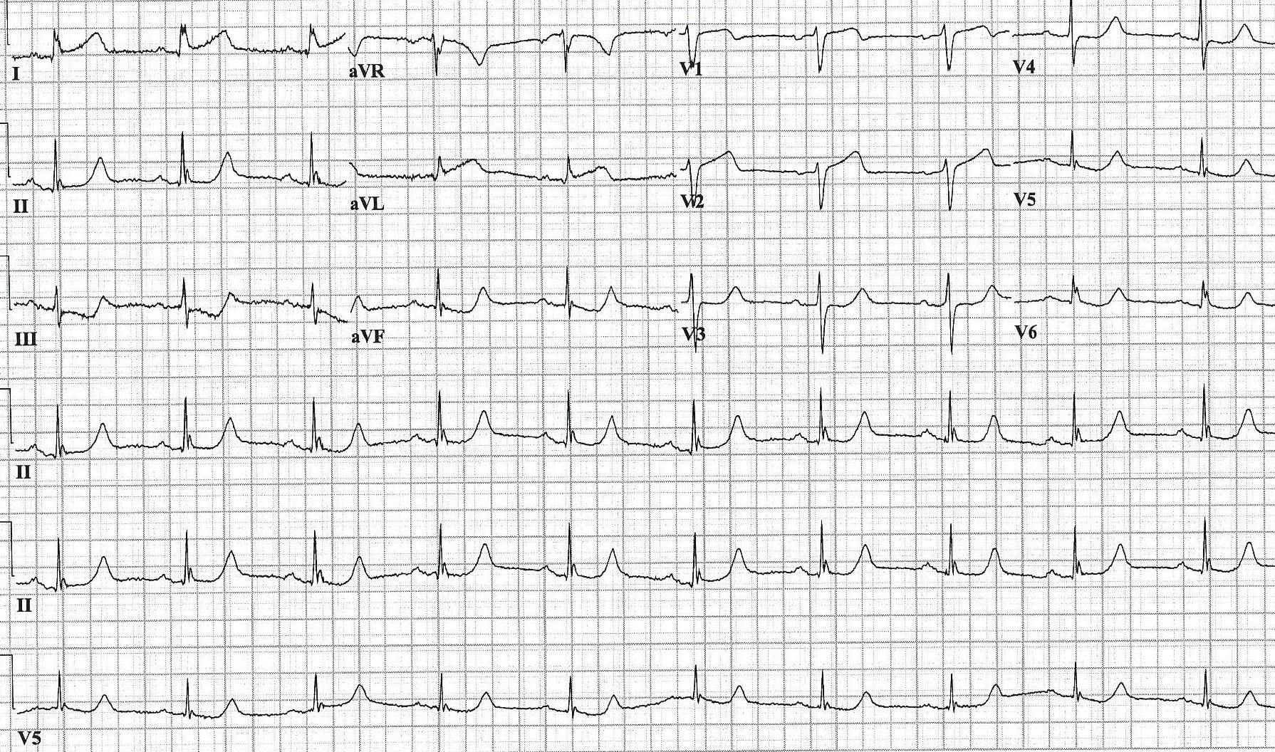 ECG printout of a patient experiencing chest pain as a result of occlusion myocardial infarction.