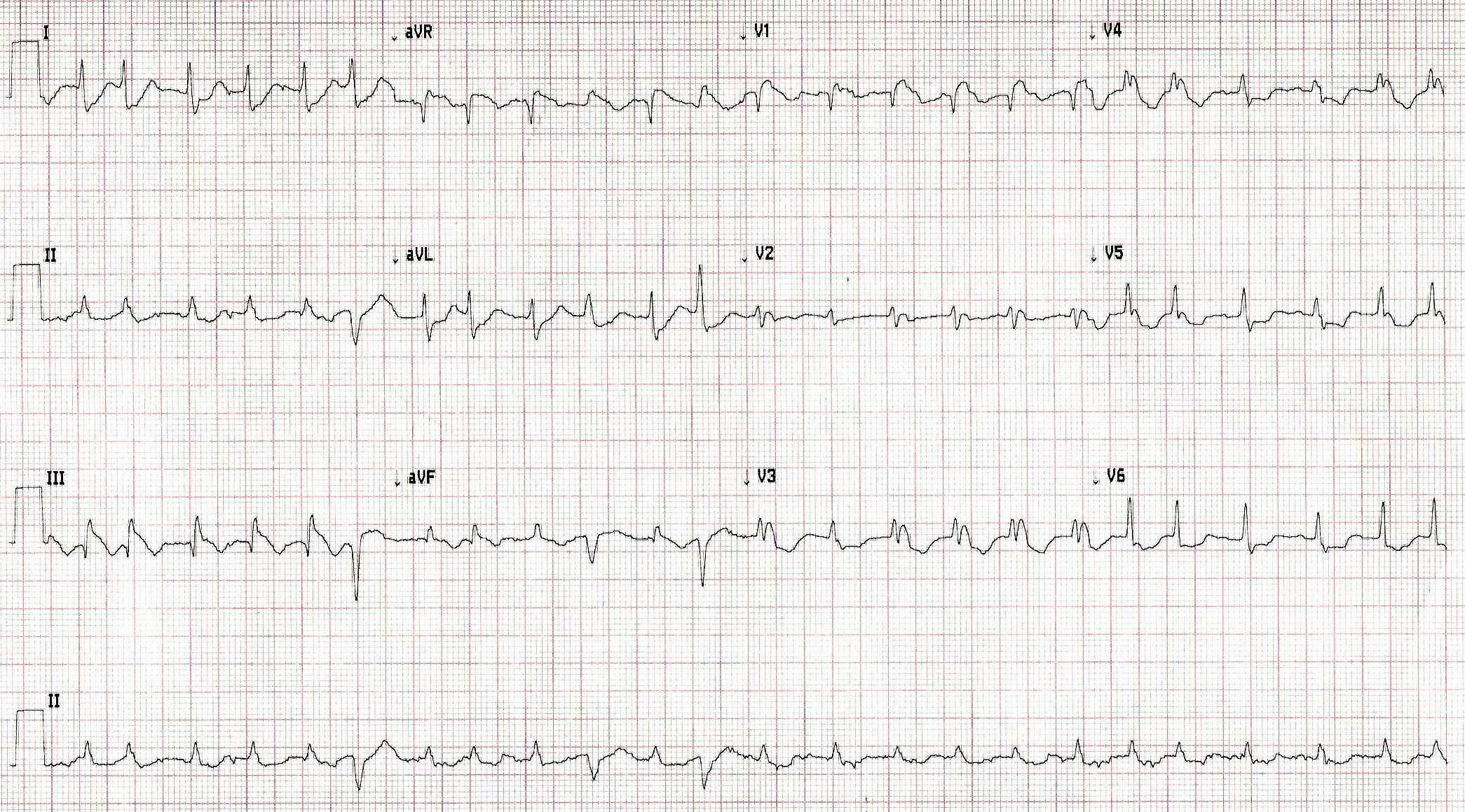 EKG Printout for an elderly patient with an acute myocardial infarction | Courtesy: Dr. Brady Pregerson