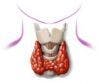 New Radiation Treatment Practice Recommendations for Thyroid Disease