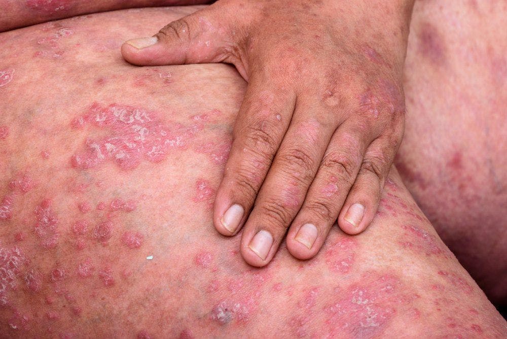 Ustekinumab Linked to Lower Serious Infection Rates in Psoriasis and Psoriatic A