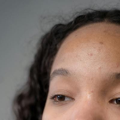 New Patient-Reported, Quality of Life Assessment Tool Developed for Acne Patients