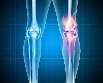 Medication/Exercise Therapy Combo Reduces Knee Pain