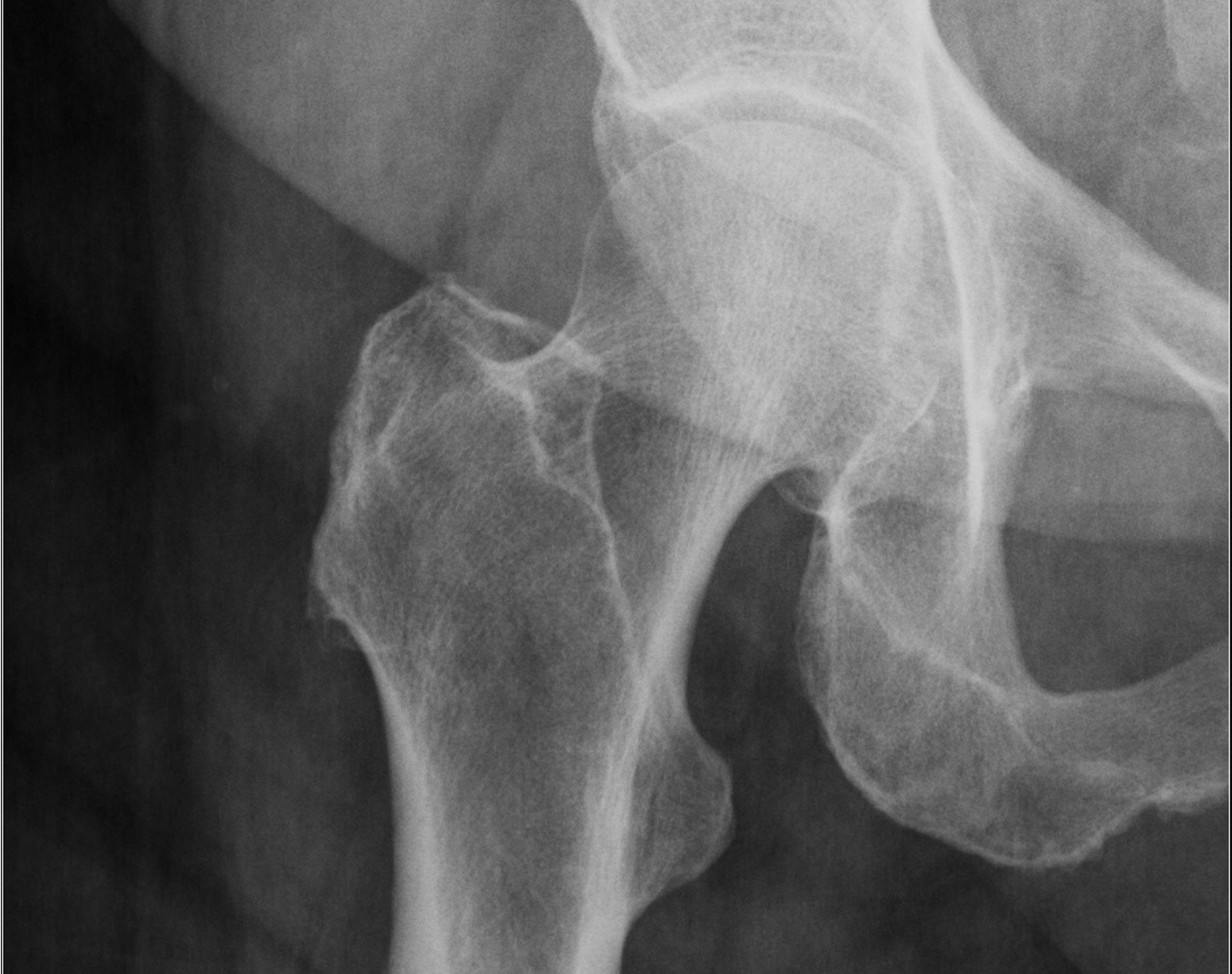 Study Finds Increases in Hospital Charges Responsible for Rising Cost of Hip Fracture Surgery