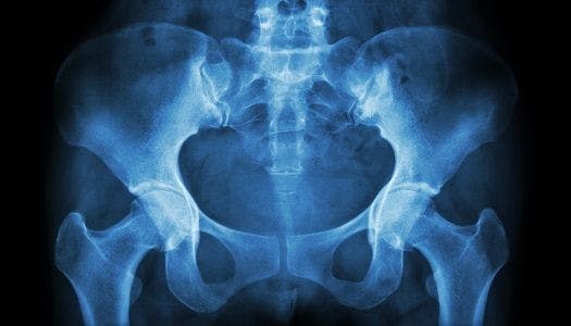Tramadol Use Shown to Increase Hip Fracture Risk in Older Adults