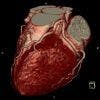 Advanced CT Offers Better Option for Detecting Coronary Artery Blockages