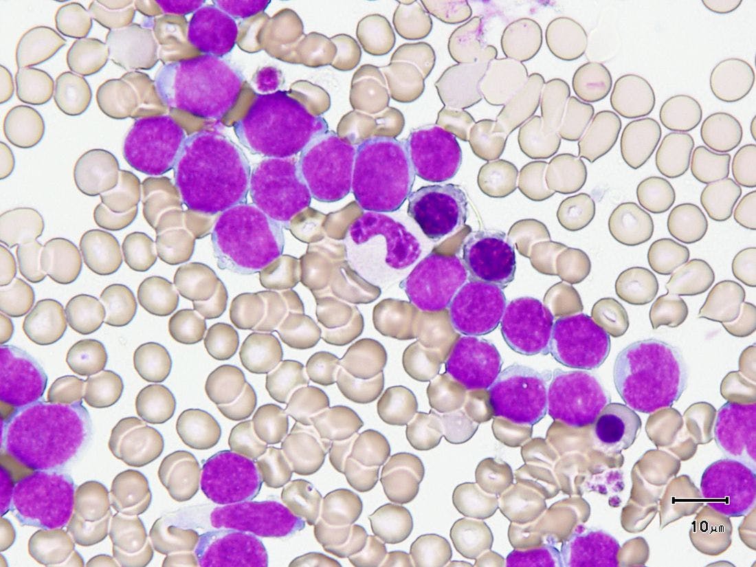 Fast Track Granted to CX-01 for Treatment of Patients Over 60 Newly Diagnosed with AML