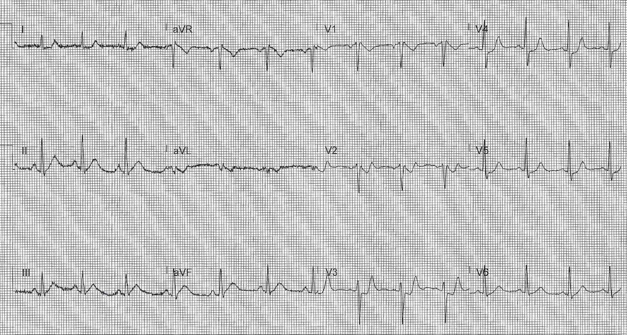 ECG computer readout of a person experiencing a heart attack. | Credit: Bardy Pregerson, MD