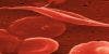Study May Disprove Sickle Cell, Gout Link 