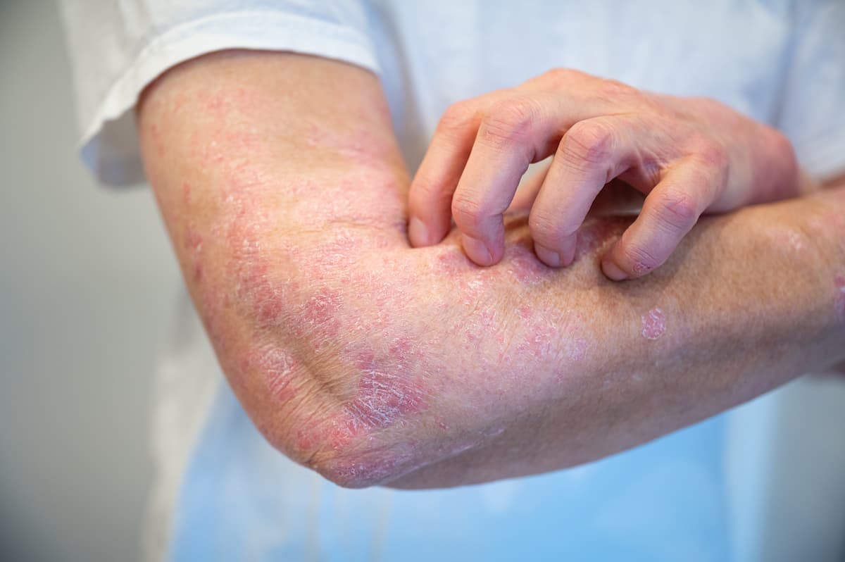 Higher Risk of Autoimmune Diseases Among Patients with Psoriatic Disease