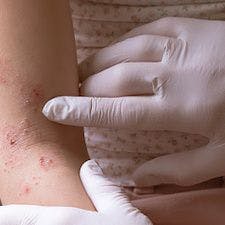 Study Highlights Major Causes, Management of Allergic Contact Dermatitis Cases