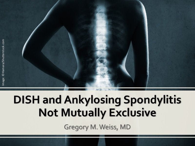 DISH and Ankylosing Spondylitis Not Mutually Exclusive