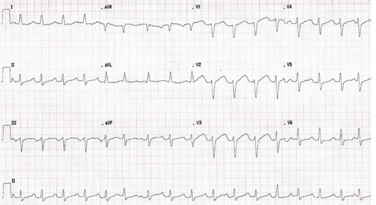 EKG of a man in his 60s.