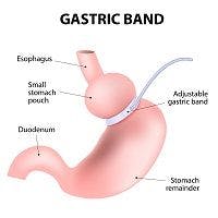 Comparing Bone Loss and Weight Loss Associated with Gastric Bypass and Gastric Banding Surgeries