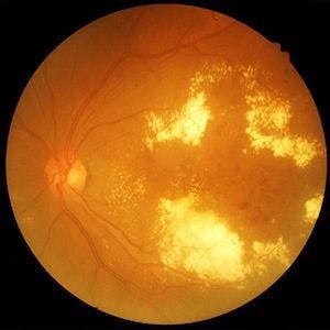Diabetic retinopathy | Credit: Adobe Images
