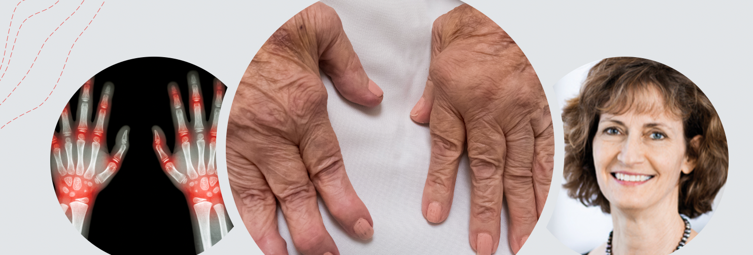 Conventional Therapy Appears as Effective as Most Biologics for Early Rheumatoid Arthritis 