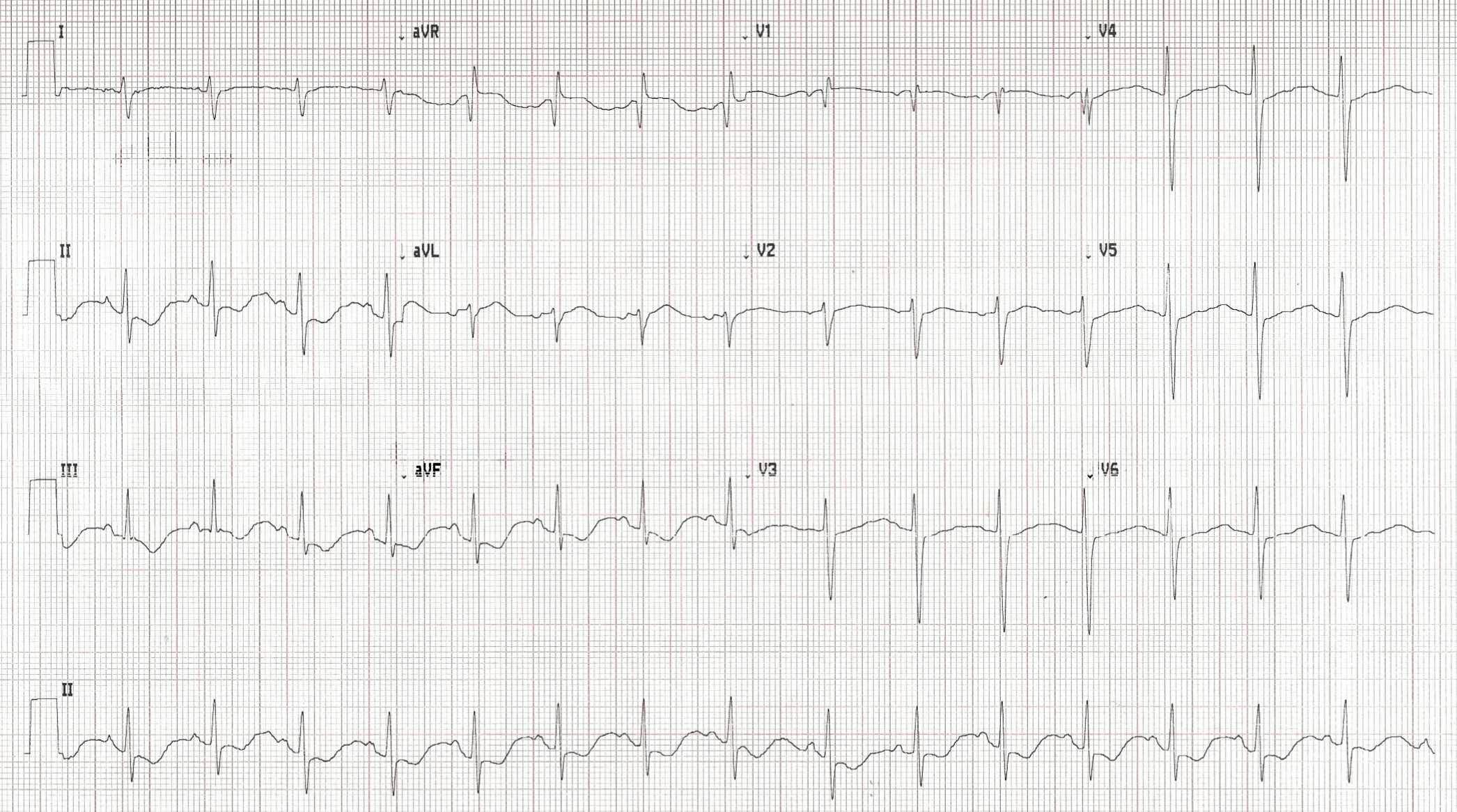Computer print out of patient ECG. | Credit: Brady Pregerson, MD