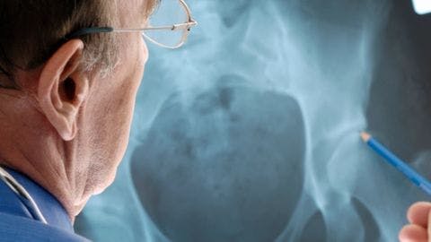 Obesity Increases Early Hip Fracture Risk in Postmenopausal Women