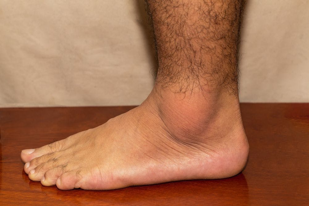 Painful gout inflammation on ankle joint. (©ShutterRyder,Shutterstock.com)
