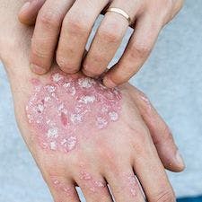 Considerable Global Prevalence of Metabolic Syndrome in Patients with Psoriasis