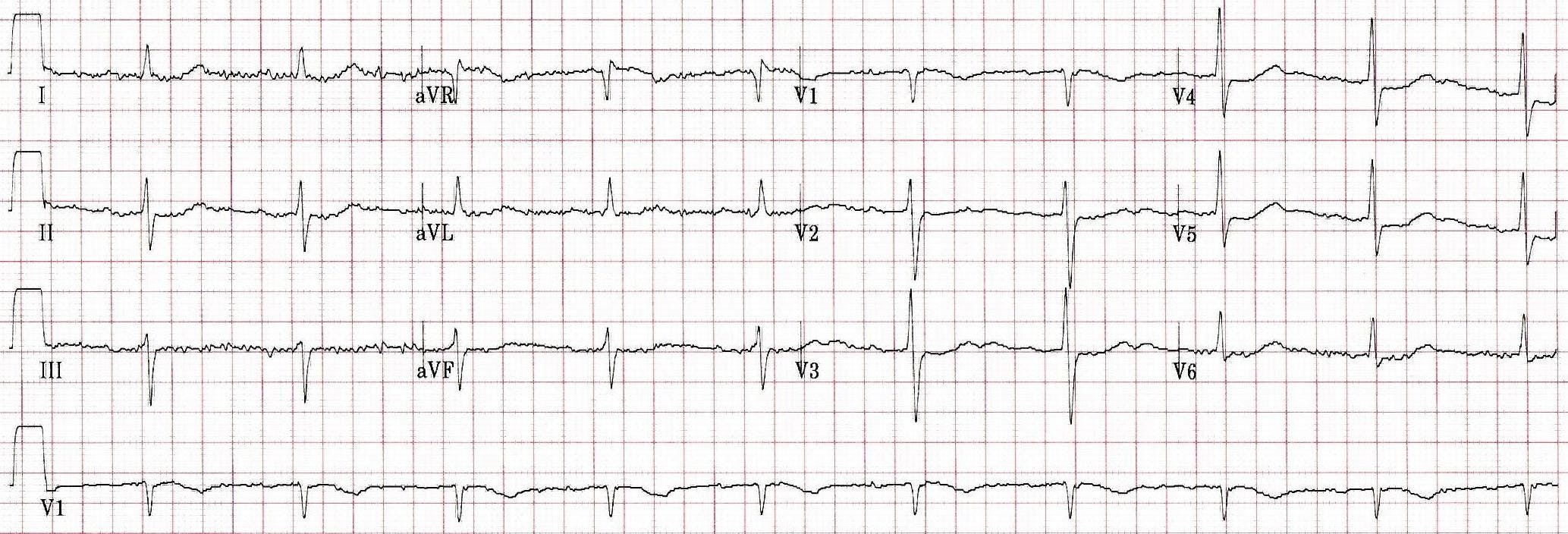EKG of a woman presenting to the hospital.