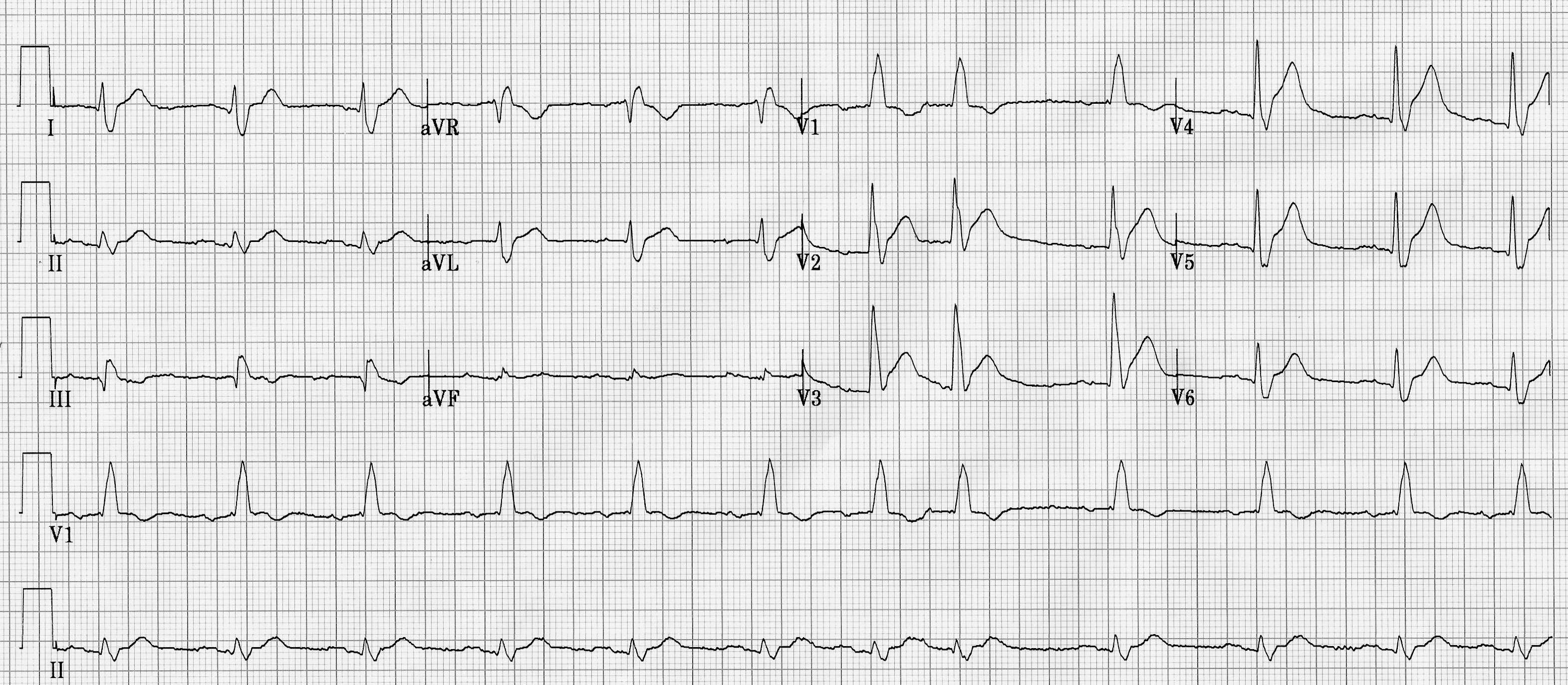 EKG printout from patient featured in case report