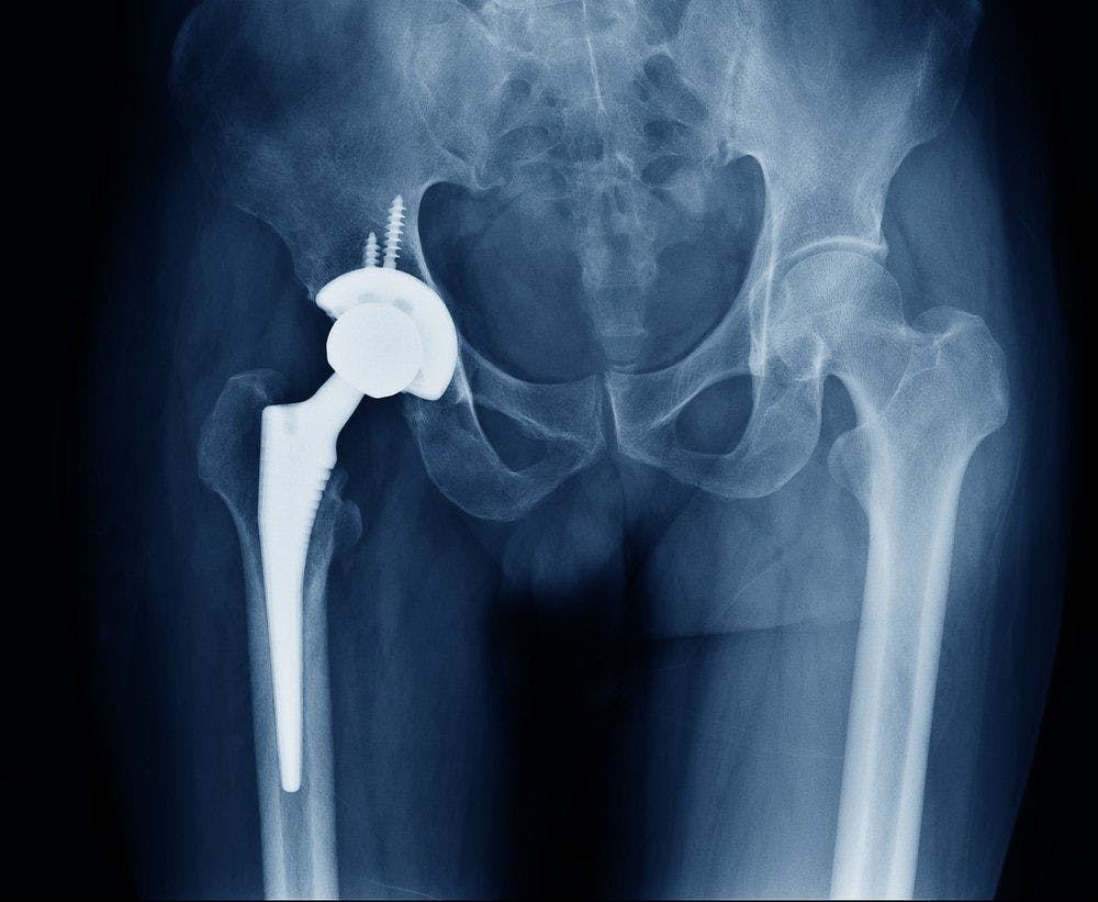 NEJM study shows total hip replacement is no better than partial replacement.