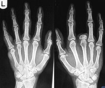 Ultrasound of Hands and Feet may Help Diagnose and Treat Rheumatoid Arthritis