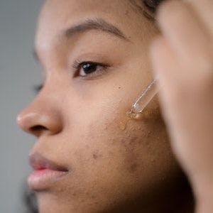 Study Observes Differences Between Late Onset and Early Onset Acne in Women