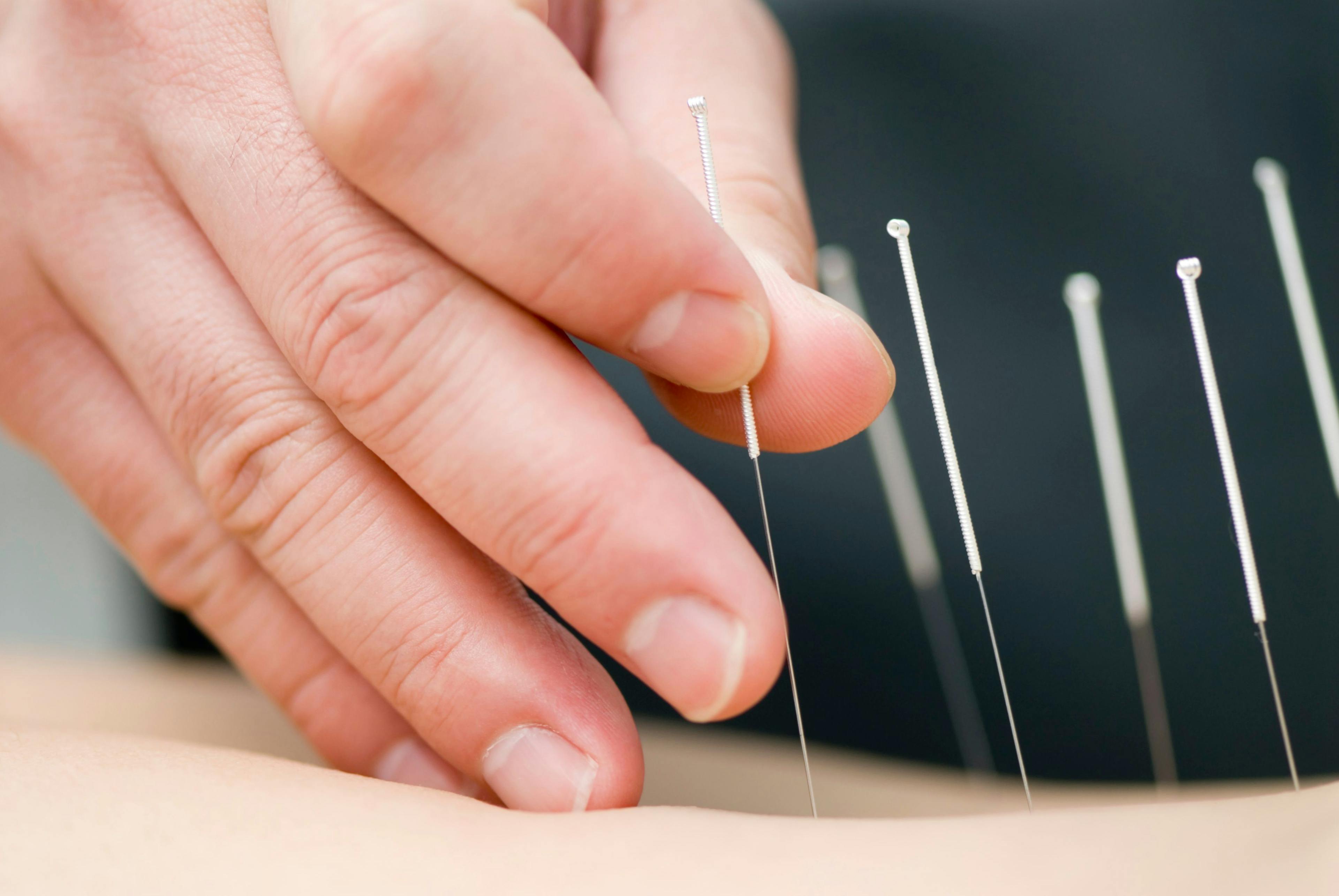 Studies Focused on Benefits of Acupuncture, Electroacupuncture Increasing in Number in Fibromyalgia 