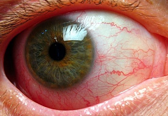 Steroid Injections May Slow Diabetes-Related Eye Disease 