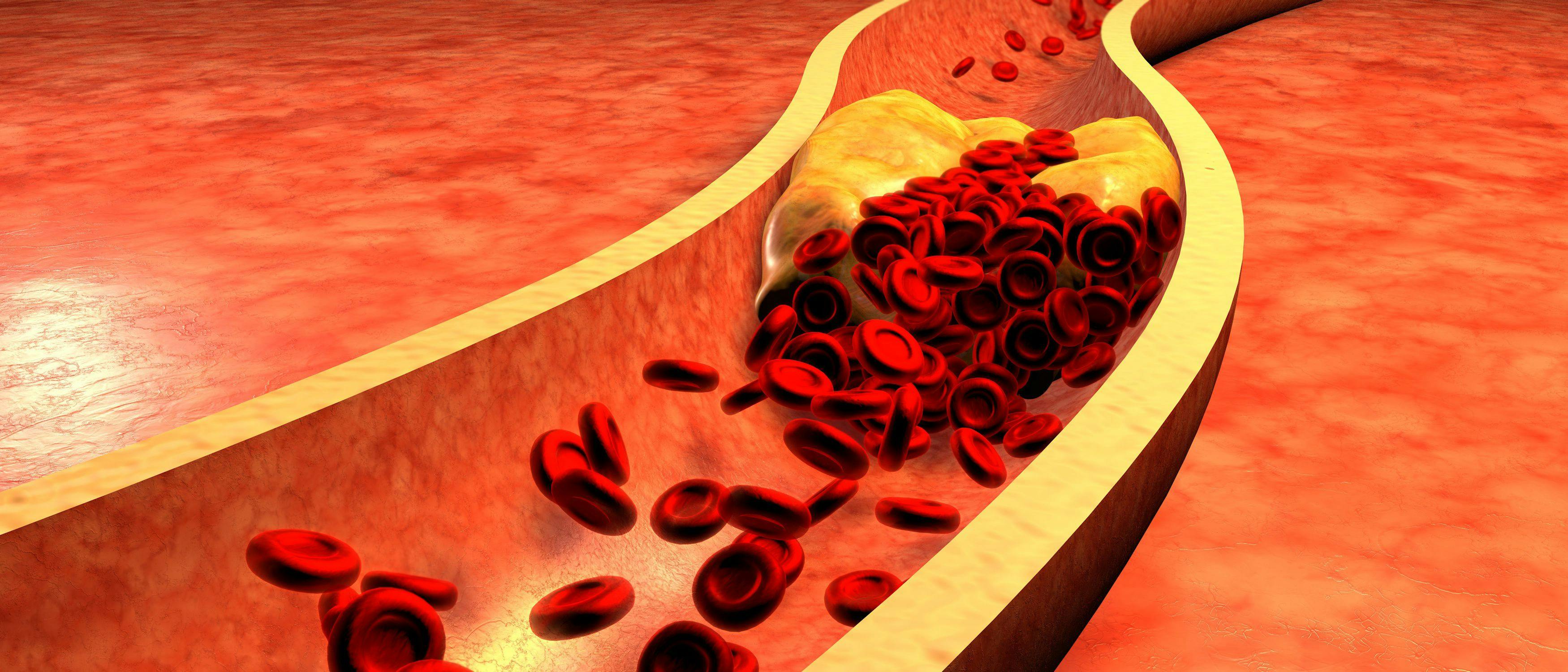 Clogged Artery with platelets and cholesterol plaque. (©Ralwe, AdobeStock.com)