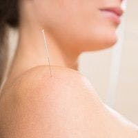 Acupuncture Can Relieve Fibromyalgia Pain, If It's Tailored Per Patient