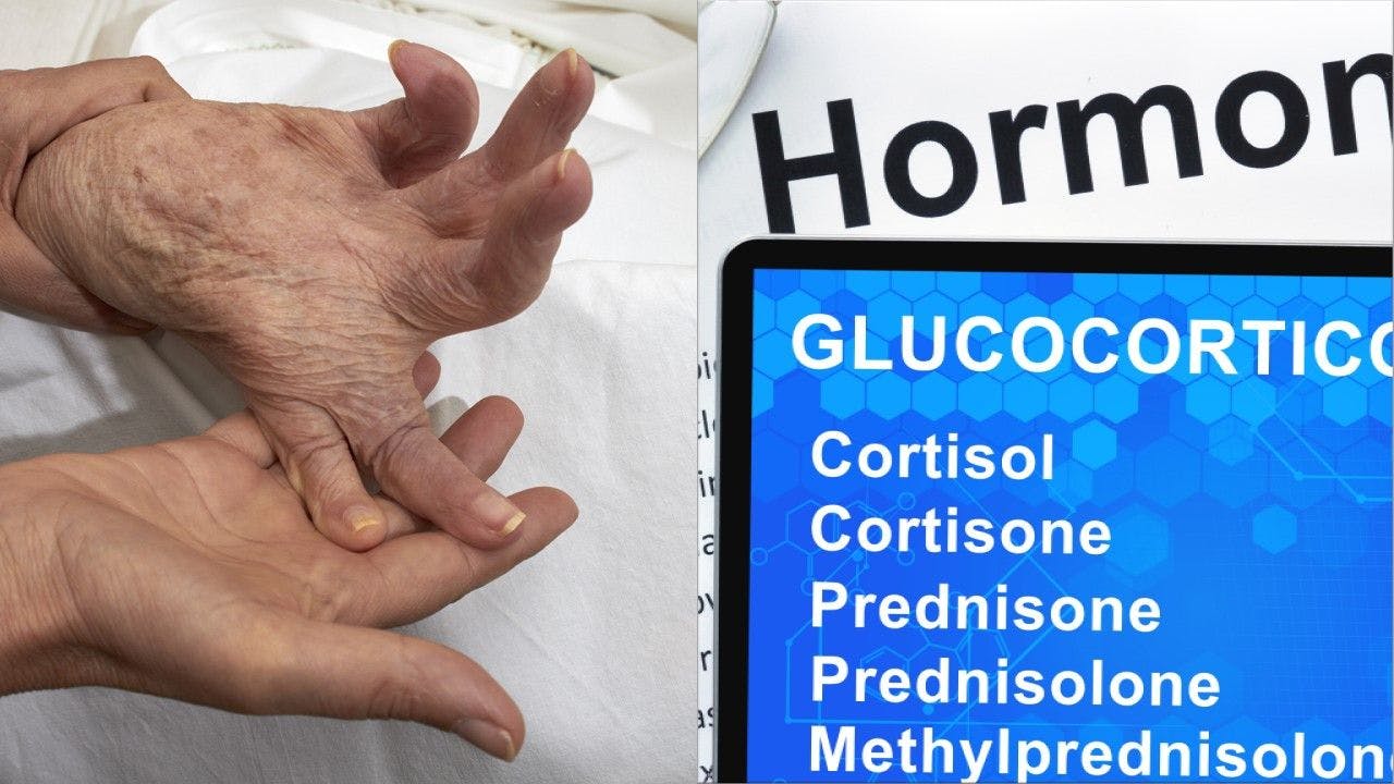 The Art of Discontinuing Glucocorticoids in Rheumatoid Arthritis