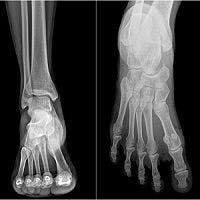 Six Common Foot and Ankle Injuries Physicians Can Easily Misdiagnose