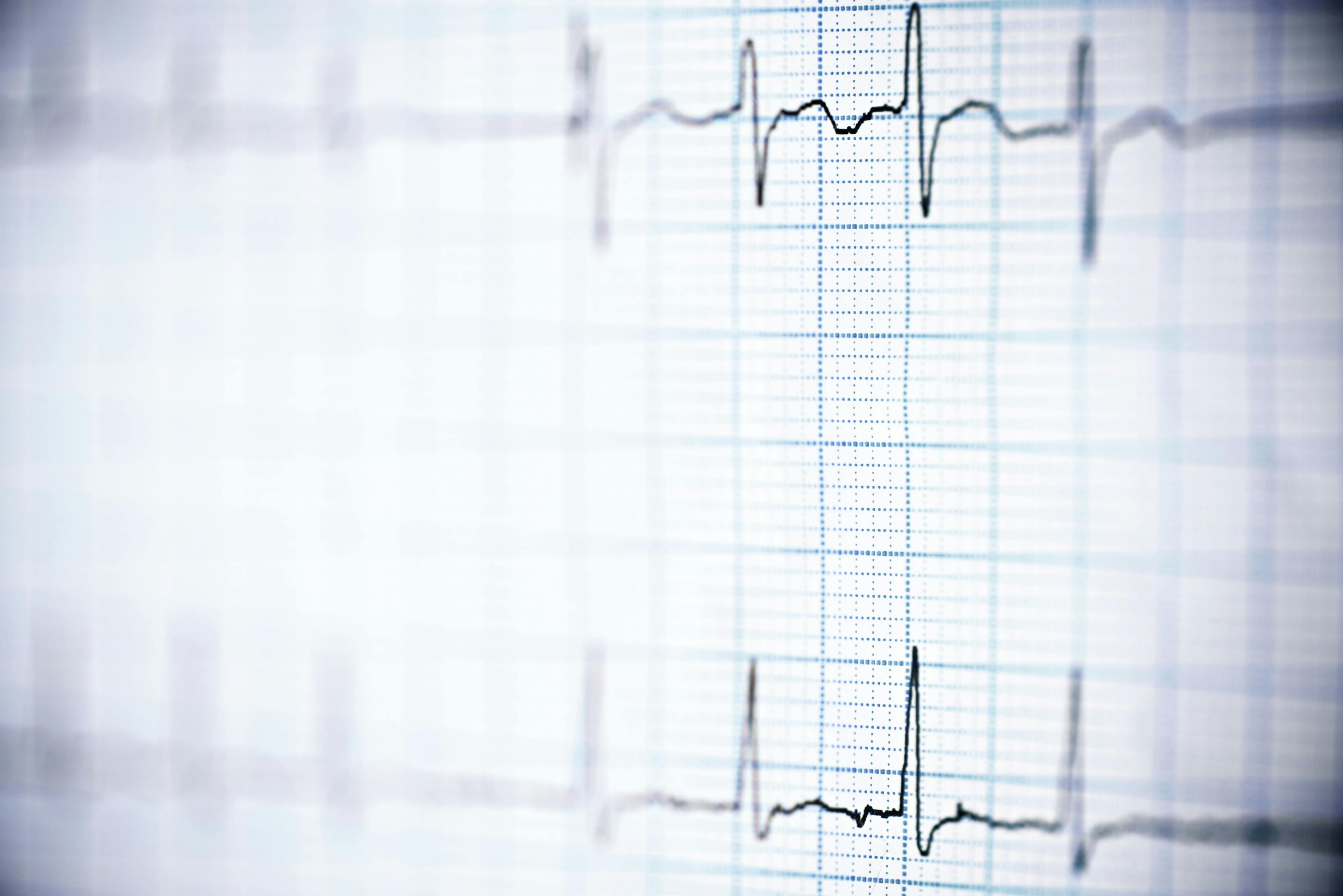Analysis Suggests Wealthier Countries Seeing Greater Incidence of AFib Deaths