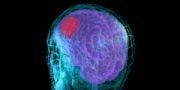 Early Research Shows Benefit for Enzyme Inhibitor in Stroke Victims