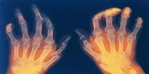 Researchers Uncover Possible Mechanism behind Rheumatoid Arthritis