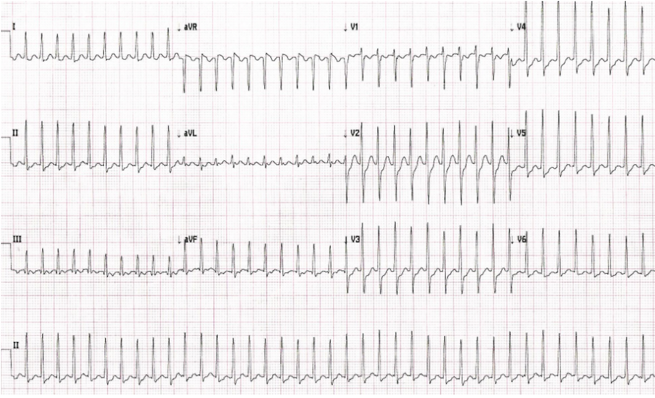 Case Report: Palpitations and Shortness of Breath
