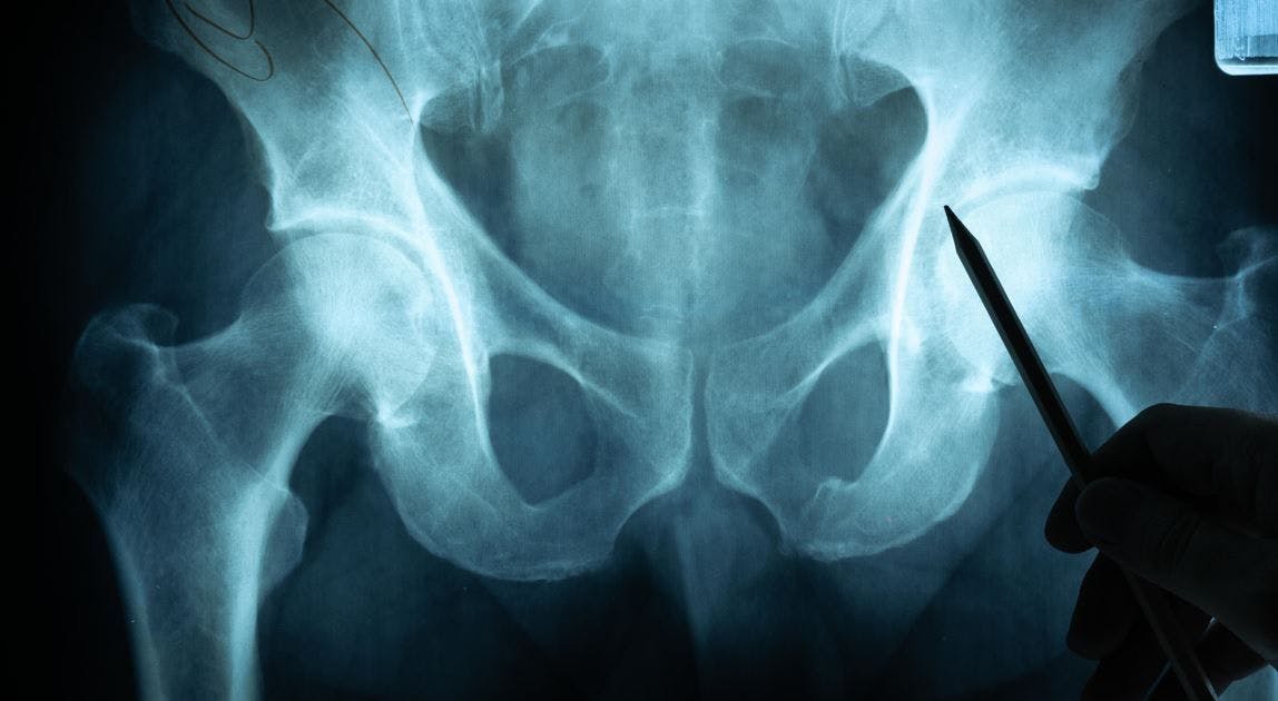 total joint surgery relieves fall risk