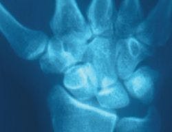 Wrist Pain in a 30-Year-Old Woman